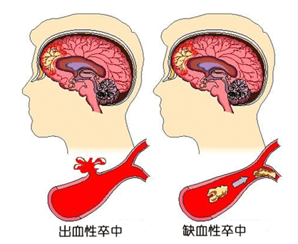 腦血管疾病TCD儀.png